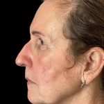 Photo of the patient’s face after the Blepharoplasty surgery. Patient 4 - Set 2