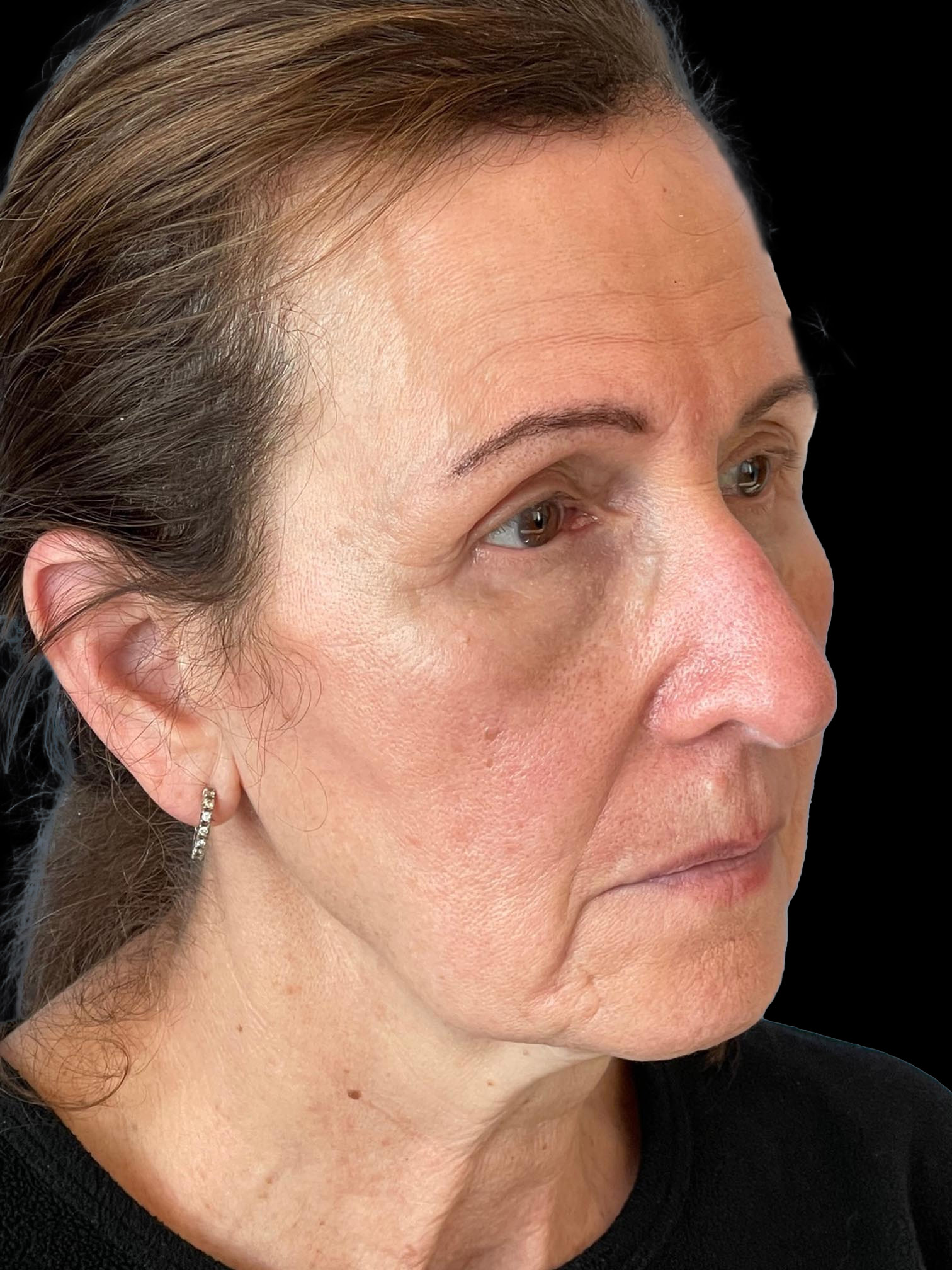 Photo of the patient’s face after the Blepharoplasty surgery. Patient 4 - Set 3