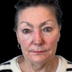 Photo of the patient’s face before the Blepharoplasty surgery. Patient 1 - Set 1