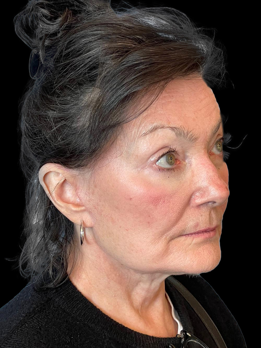 Photo of the patient’s face after the Blepharoplasty surgery. Patient 1 - Set 4