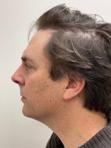 Photo of the patient’s face before the Facelift surgery. Patient 2 - Set 3