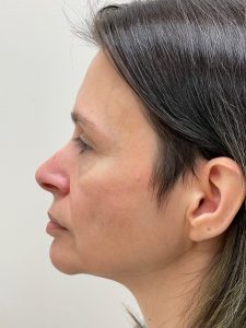 Photo of the patient’s face before the Facelift surgery. Patient 1 - Set 3