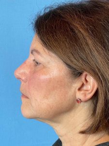 Photo of the patient’s face before the Facelift surgery. Patient 3 - Set 3