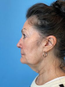 Photo of the patient’s face before the Facelift surgery. Patient 5 - Set 3
