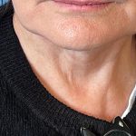 Photo of the patient’s face after the Facelift surgery. Patient 5 - Set 7