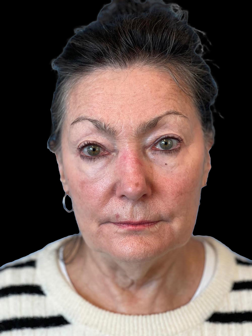 Photo of the patient’s face before the Facelift surgery. Patient 5 - Set 1