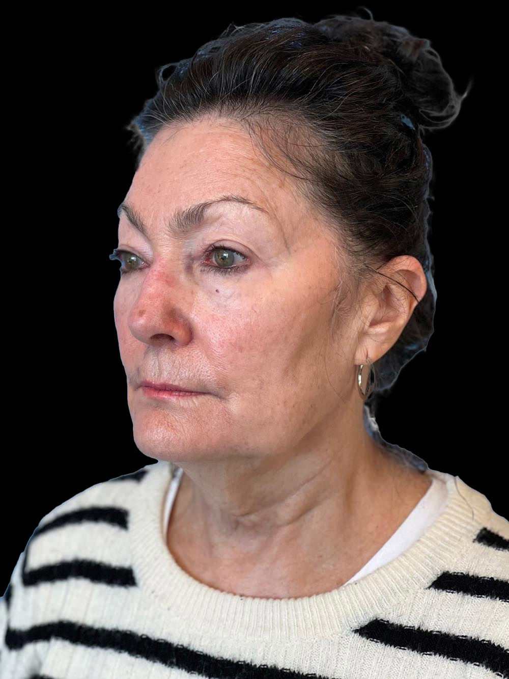 Photo of the patient’s face before the Facelift surgery. Patient 5 - Set 2