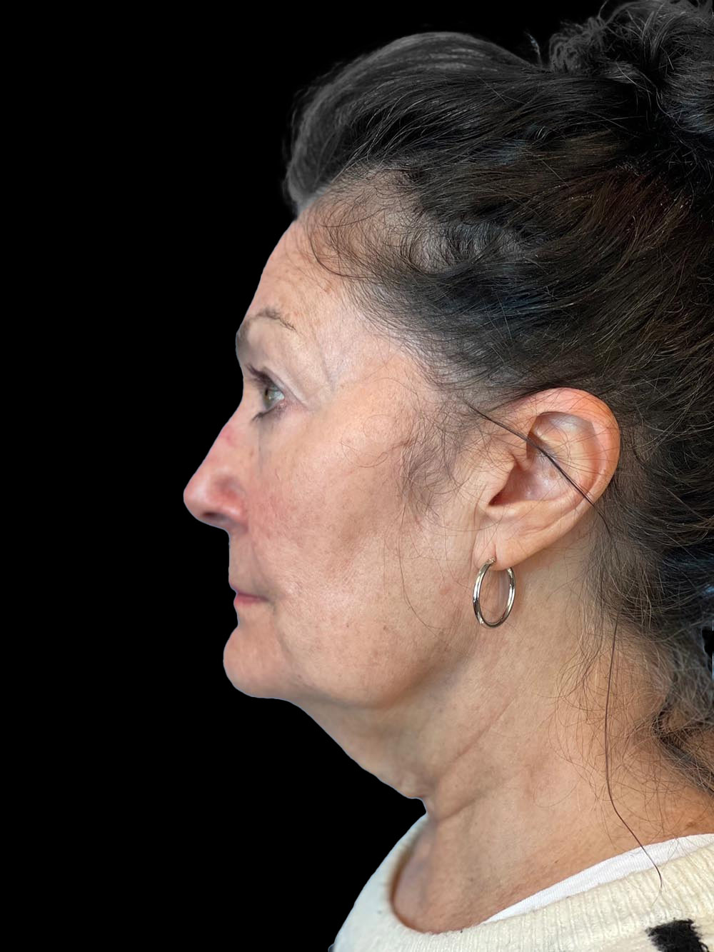 Photo of the patient’s face before the Facelift surgery. Patient 5 - Set 3