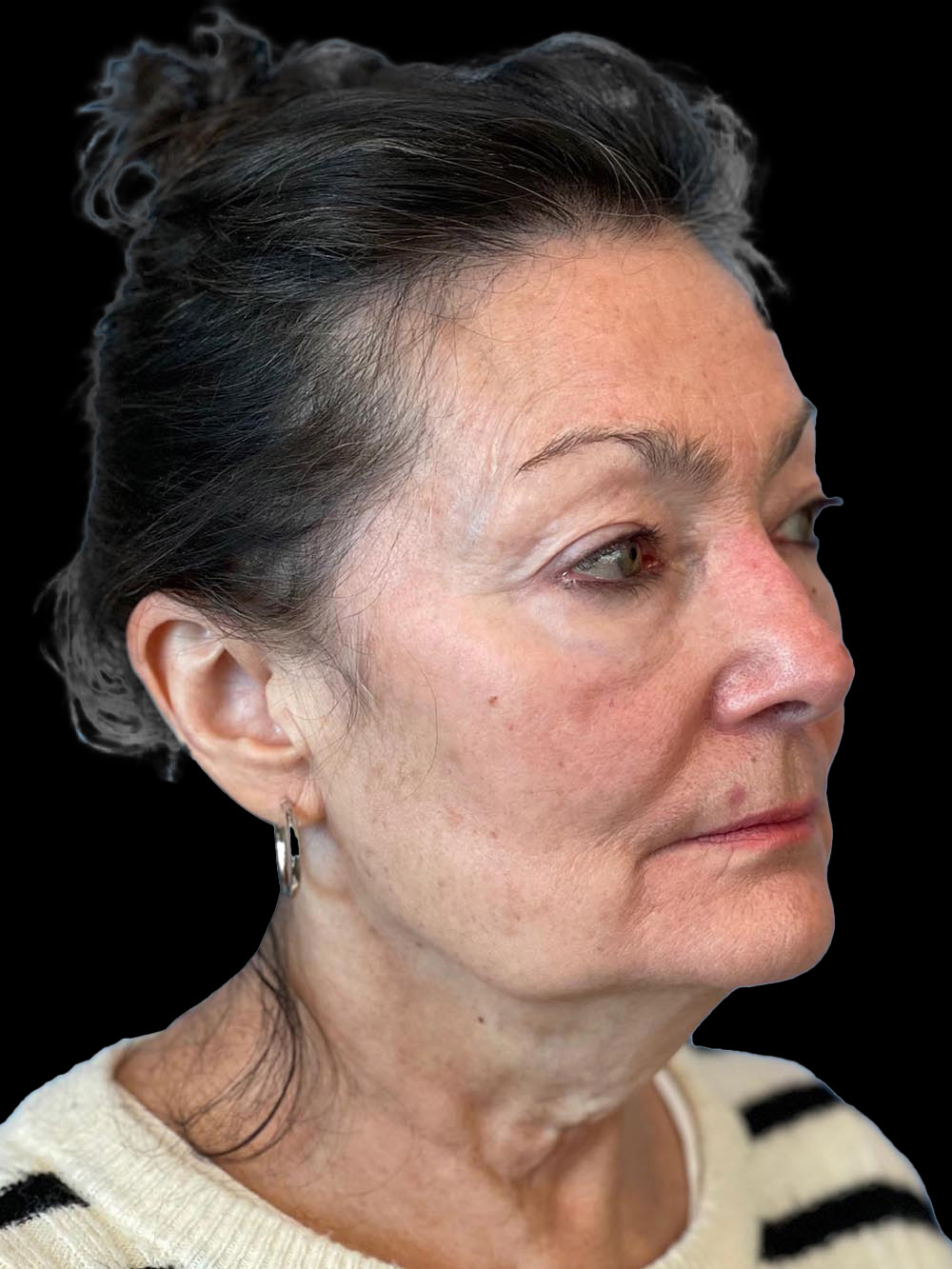 Photo of the patient’s face before the Facelift surgery. Patient 5 - Set 4