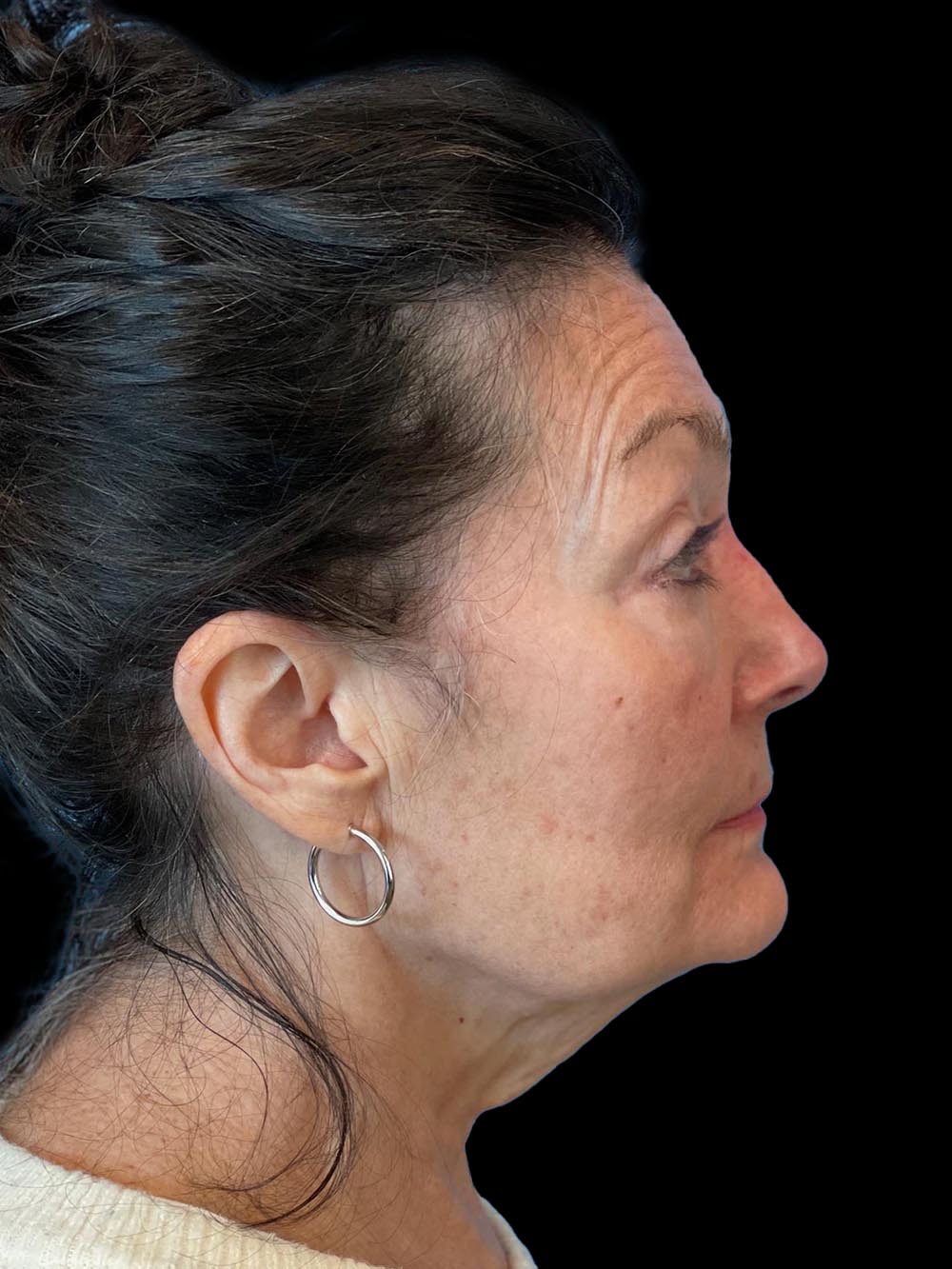 Photo of the patient’s face before the Facelift surgery. Patient 5 - Set 5