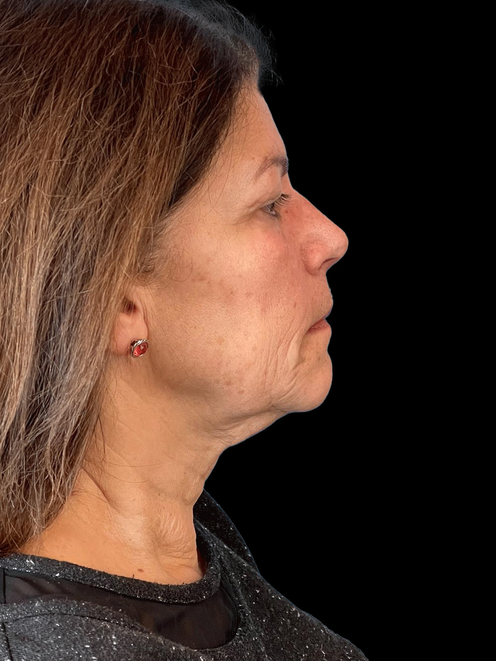 Photo of the patient’s face before the Facelift surgery. Patient 3 - Set 5