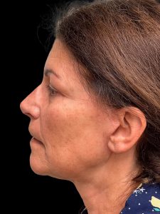 Photo of the patient’s face after the Facelift surgery. Patient 3 - Set 3