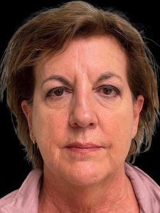 Photo of the patient’s face before the Facelift surgery. Patient 4 - Set 1
