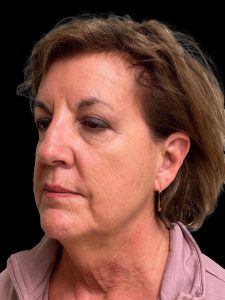 Photo of the patient’s face before the Facelift surgery. Patient 4 - Set 2