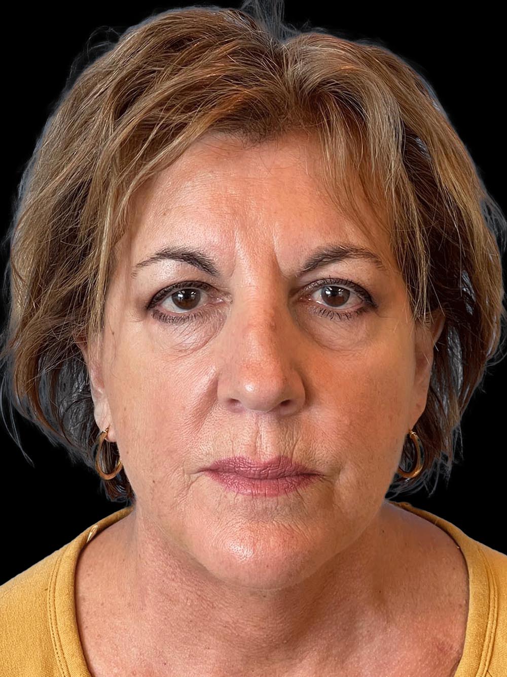 Photo of the patient’s face after the Facelift surgery. Patient 4 - Set 1