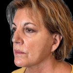 Photo of the patient’s face after the Facelift surgery. Patient 4 - Set 2