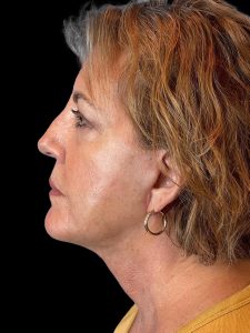 Photo of the patient’s face after the Facelift surgery. Patient 4 - Set 3