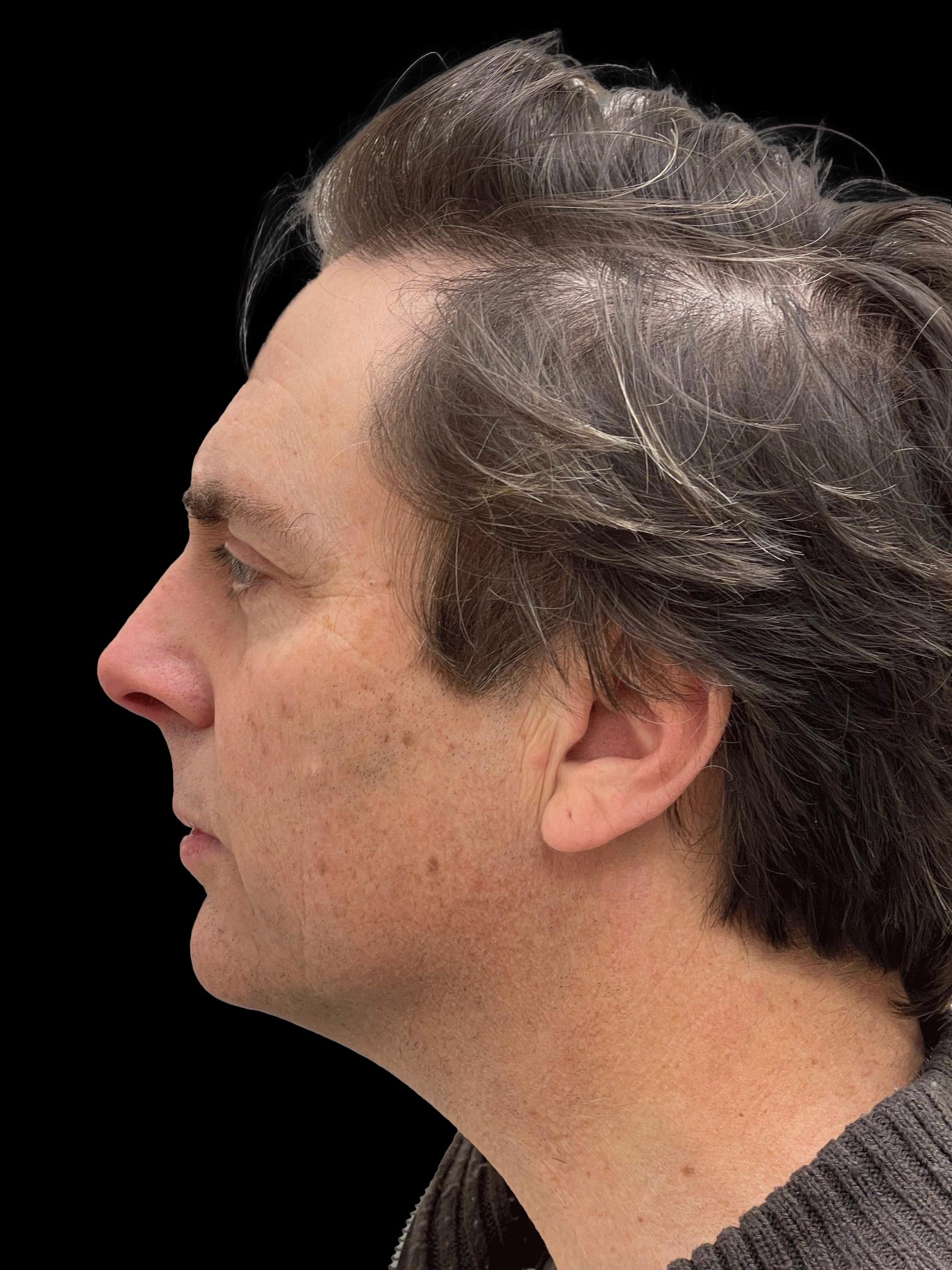 Photo of the patient’s face before the Facelift surgery. Patient 2 - Set 3