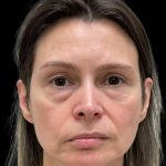 Photo of the patient’s face before the Facelift surgery. Patient 1 - Set 1