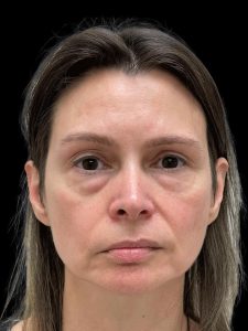 Photo of the patient’s face before the Facelift surgery. Patient 1 - Set 1