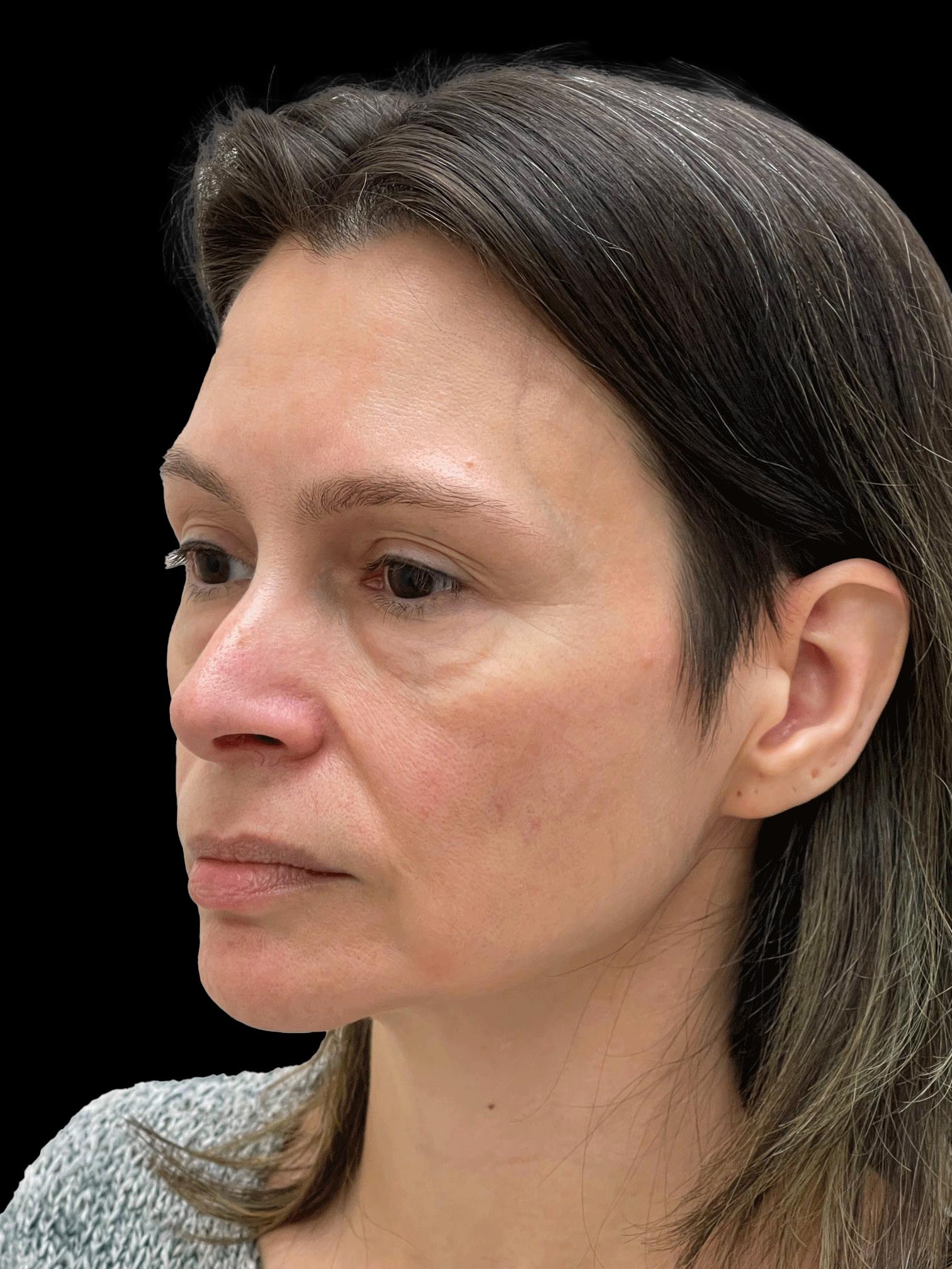 Photo of the patient’s face before the Facelift surgery. Patient 1 - Set 2