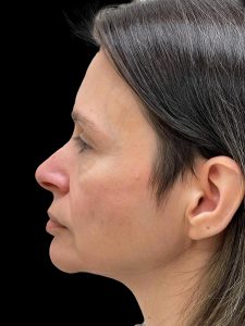 Photo of the patient’s face before the Facelift surgery. Patient 1 - Set 3