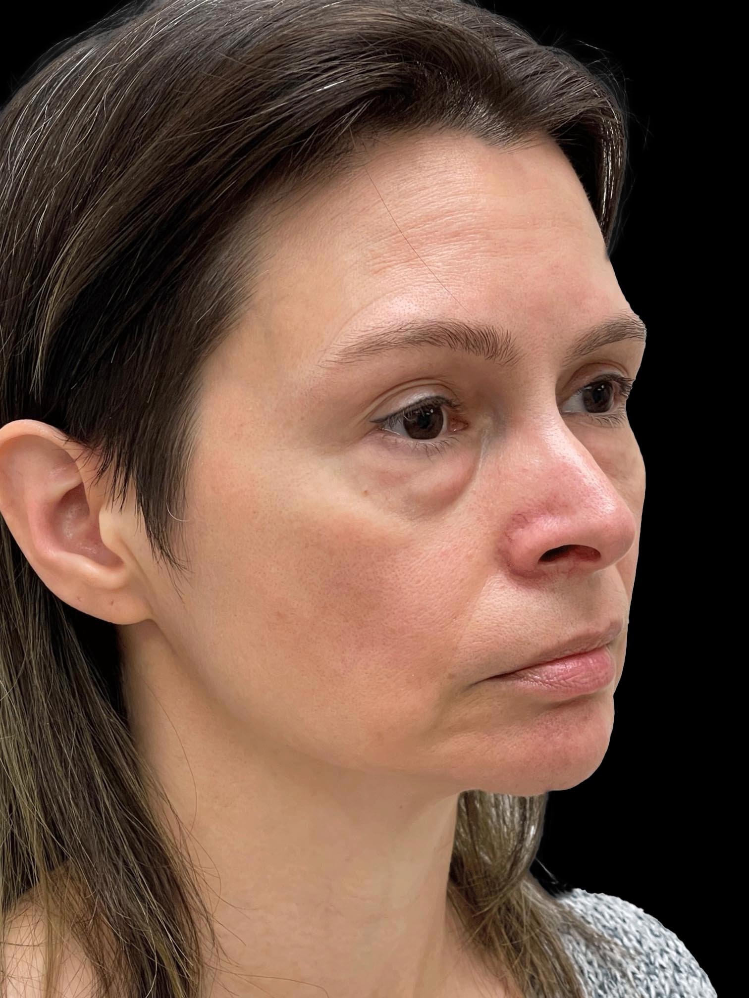 Photo of the patient’s face before the Facelift surgery. Patient 1 - Set 4