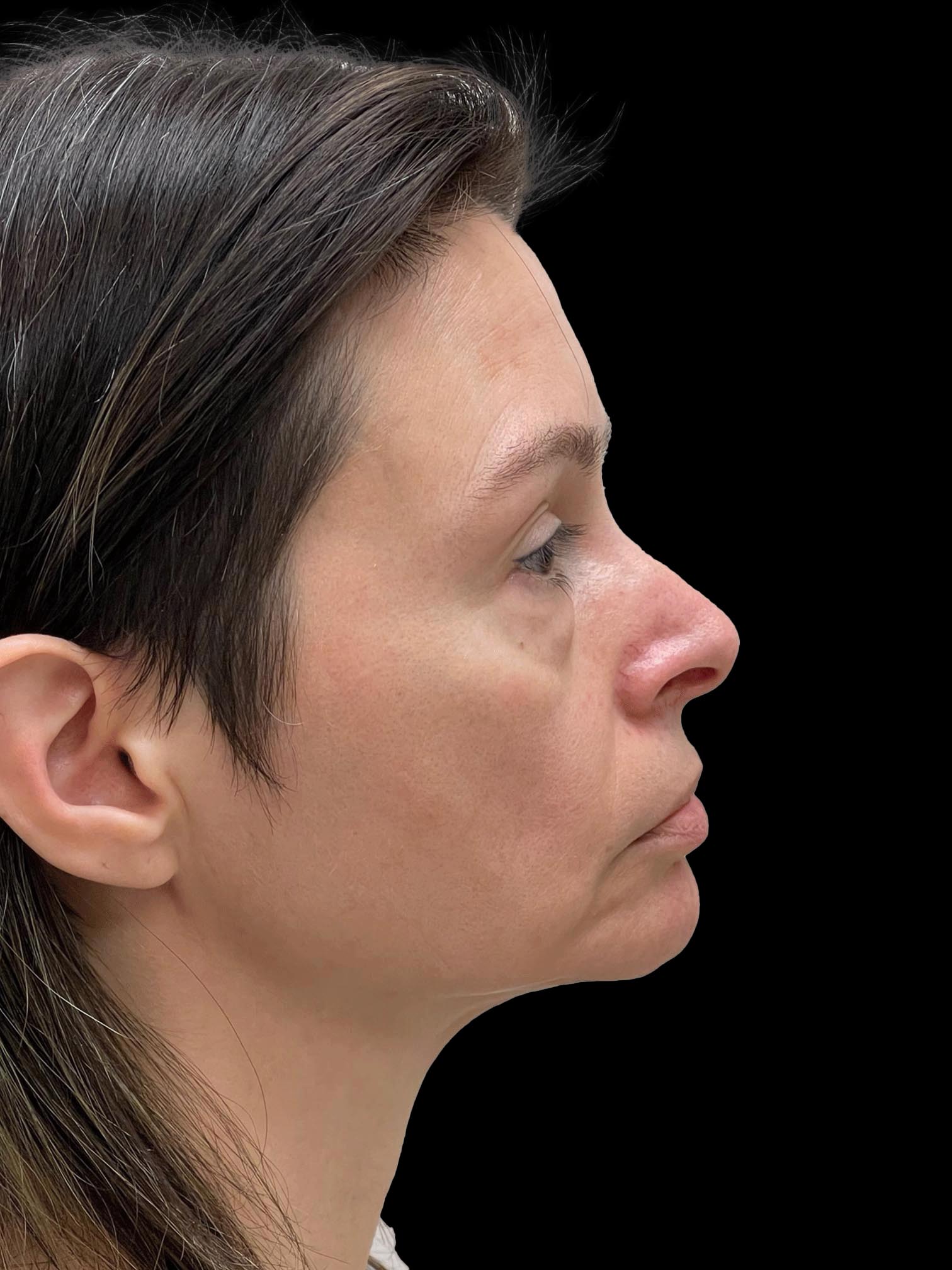 Photo of the patient’s face before the Facelift surgery. Patient 1 - Set 5