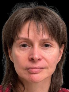 Photo of the patient’s face after the Facelift surgery. Patient 1 - Set 1