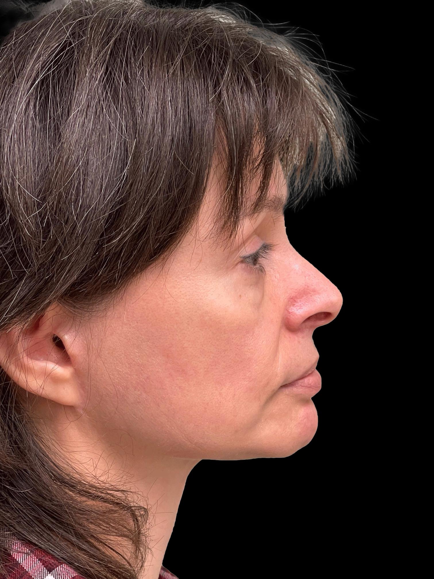 Photo of the patient’s face after the Facelift surgery. Patient 1 - Set 5