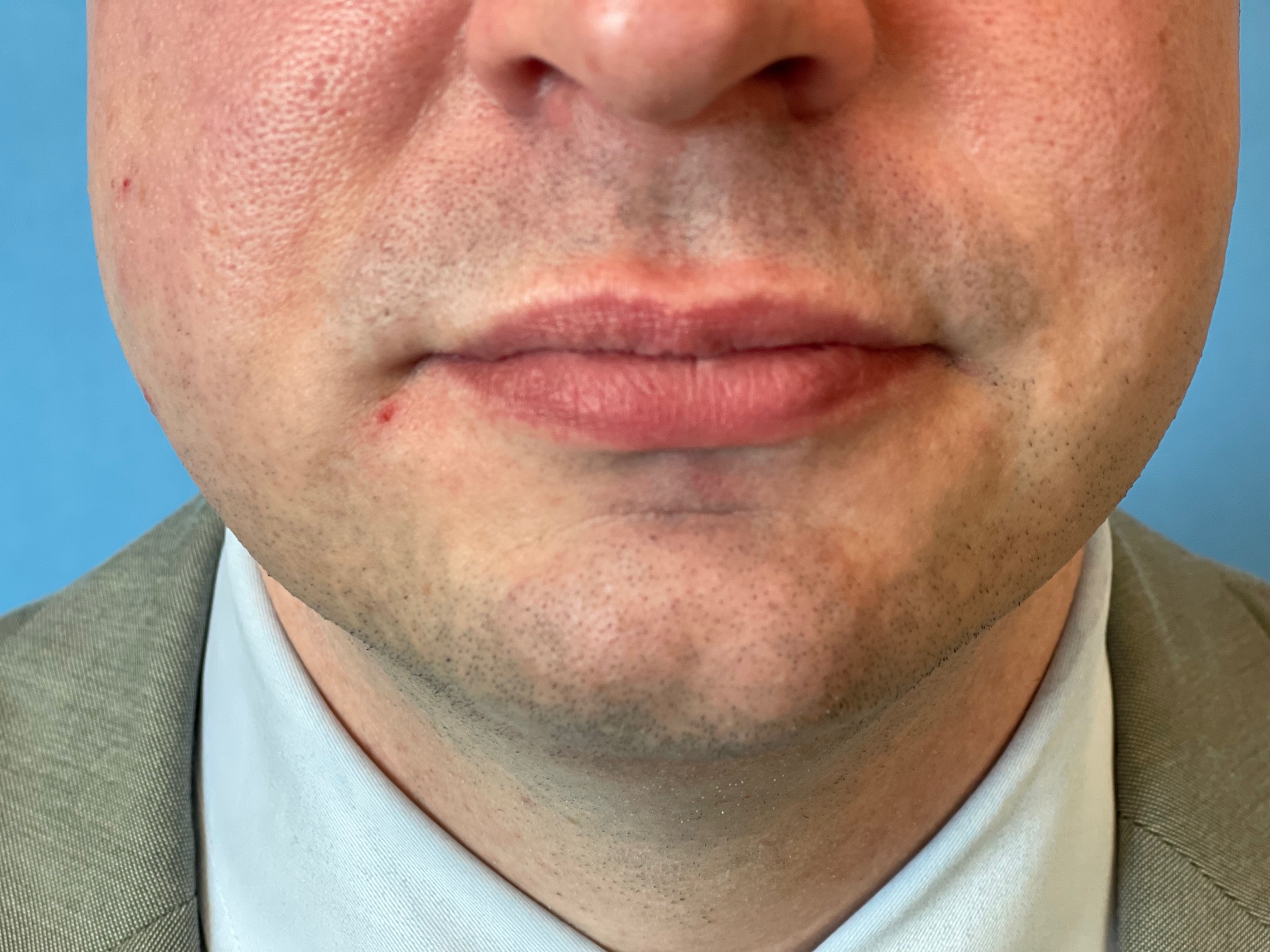 Photo of the patient’s face before the Necklift surgery. Patient 8 - Set 6