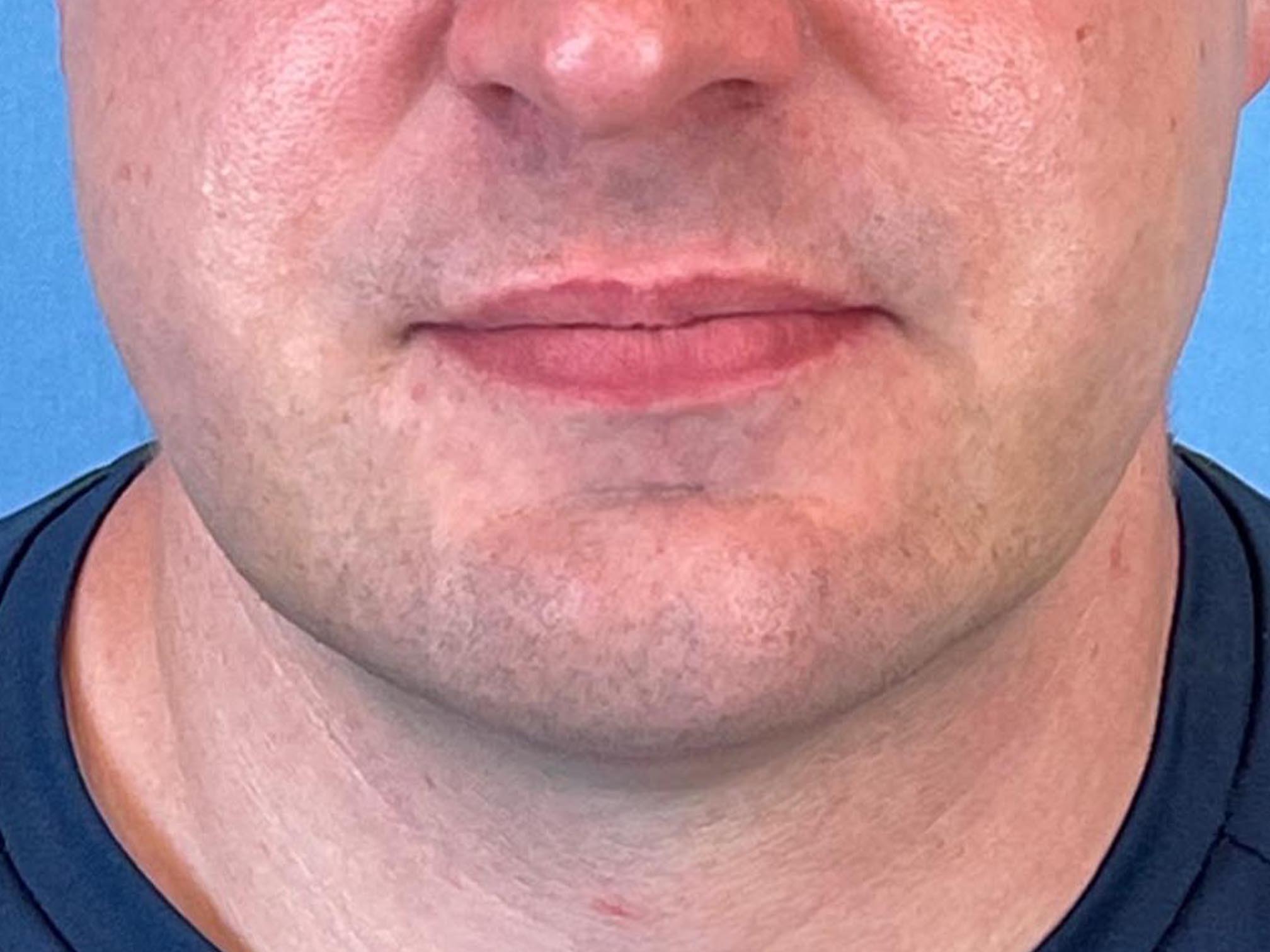 Photo of the patient’s face after the Necklift surgery. Patient 8 - Set 6