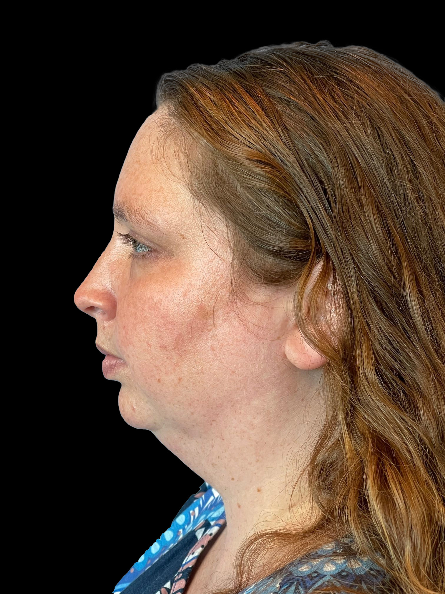 Photo of the patient’s face before the Necklift surgery. Patient 3 - Set 3