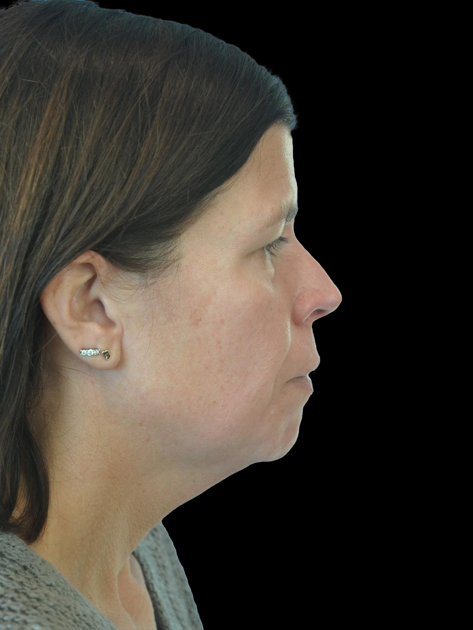 Photo of the patient’s face before the Necklift surgery. Patient 7 - Set 5