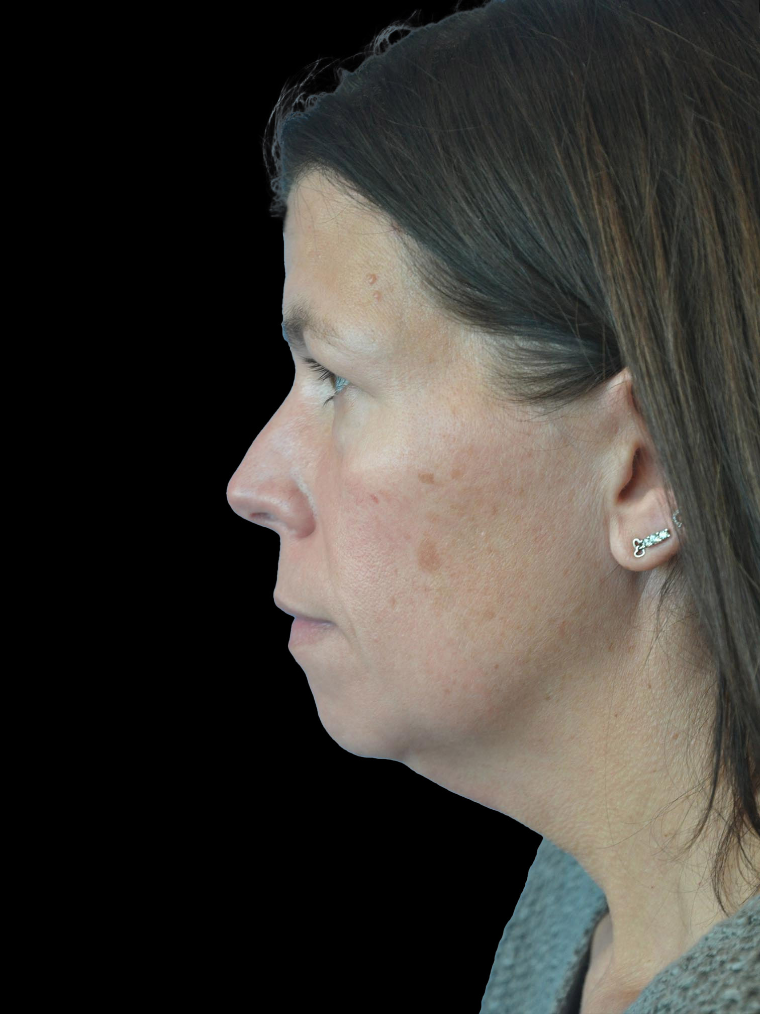 Photo of the patient’s face before the Necklift surgery. Patient 7 - Set 3