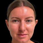 Photo of the patient’s face before the Otoplasty surgery. Patient 2 - Set 1