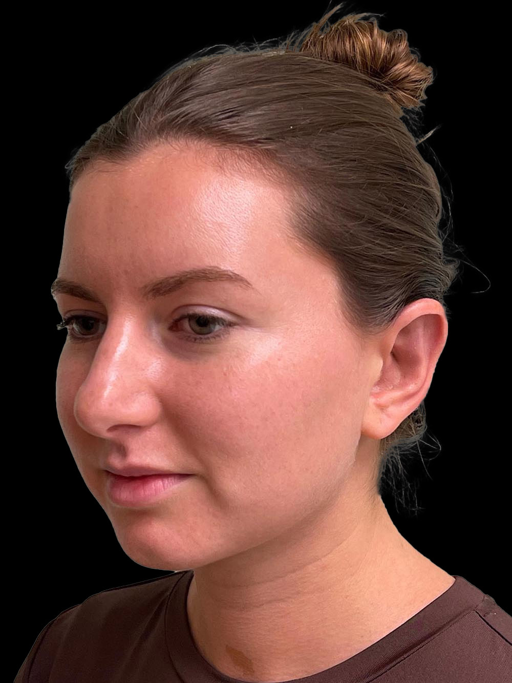 Photo of the patient’s face after the Otoplasty surgery. Patient 2 - Set 2