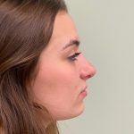 Photo of the patient’s face after the Rhinoplasty surgery. Patient 1 - Set 5