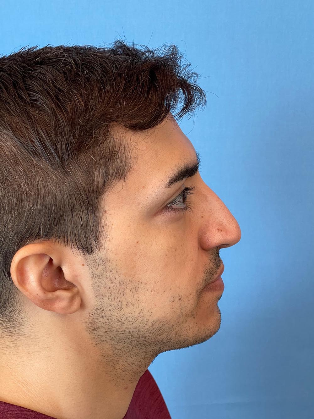 Photo of the patient’s face before the Rhinoplasty surgery. Patient 2 - Set 5