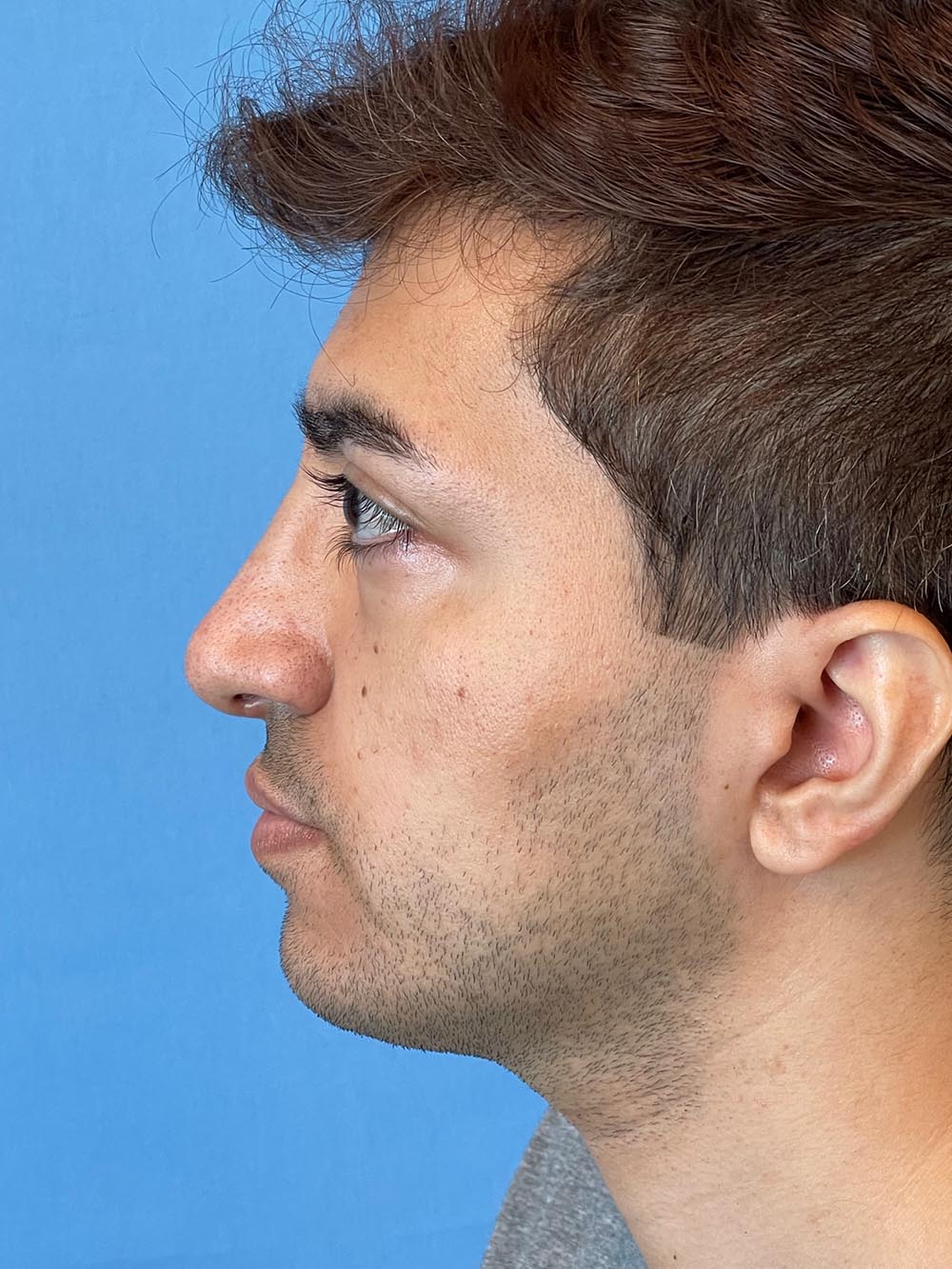 Photo of the patient’s face after the Rhinoplasty surgery. Patient 2 - Set 3