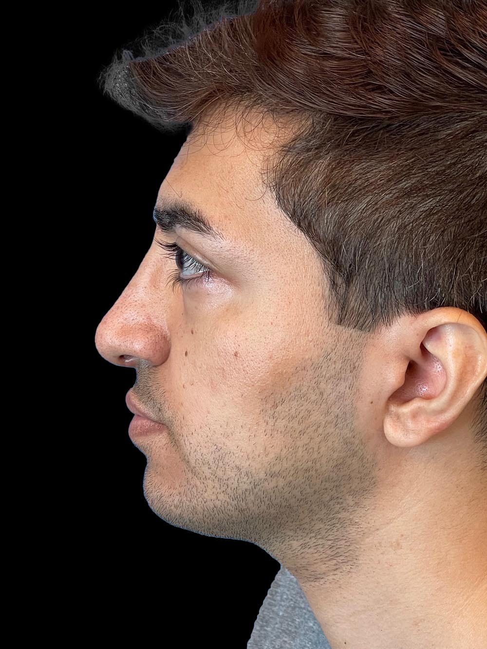 Photo of the patient’s face after the Rhinoplasty surgery. Patient 2 - Set 3