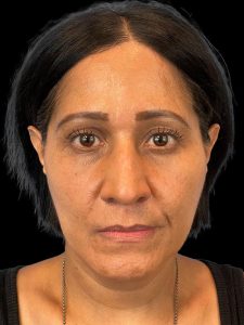 Photo of the patient’s face before the Rhinoplasty surgery. Patient 3 - Set 1