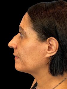 Photo of the patient’s face before the Rhinoplasty surgery. Patient 3 - Set 3
