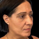 Photo of the patient’s face before the Rhinoplasty surgery. Patient 3 - Set 4