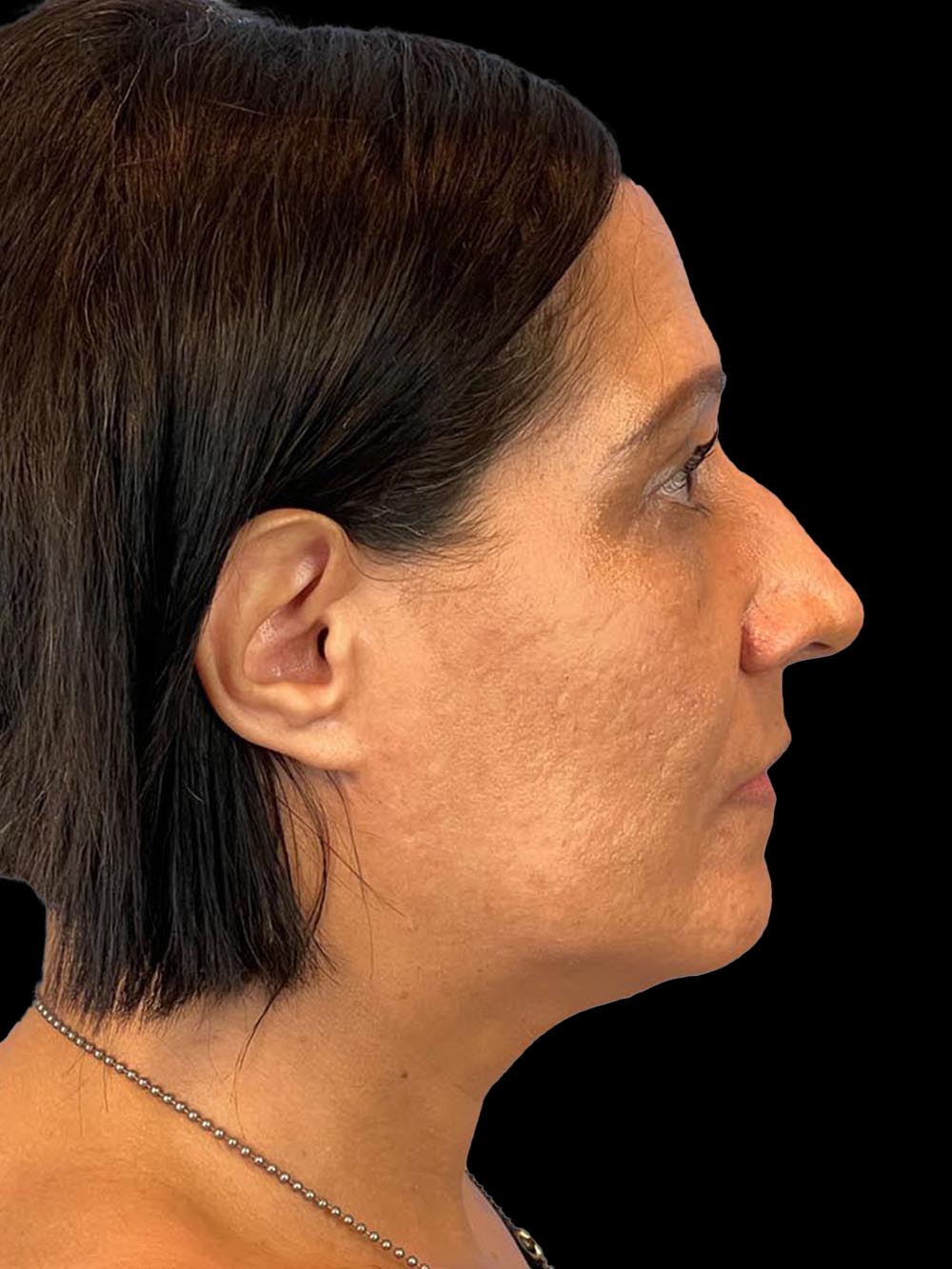 Photo of the patient’s face before the Rhinoplasty surgery. Patient 3 - Set 5