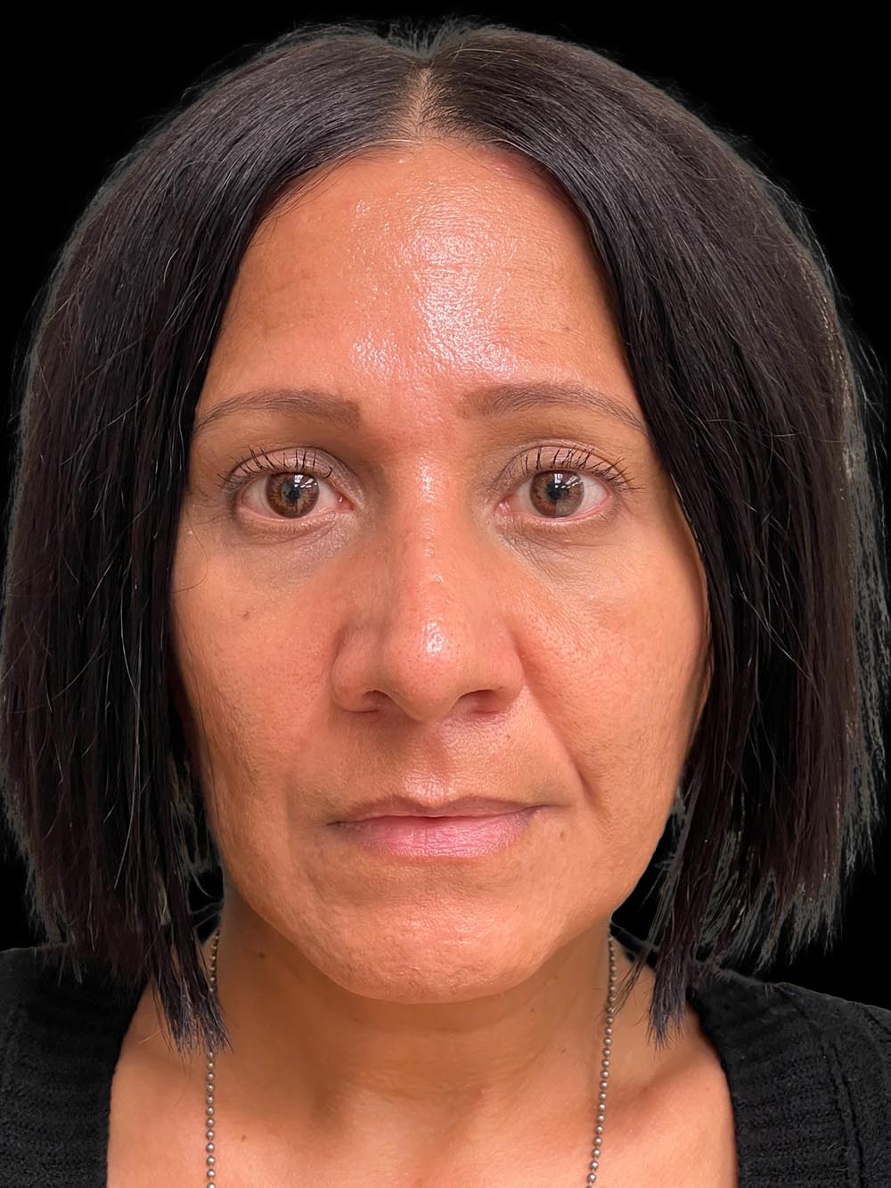 Photo of the patient’s face after the Rhinoplasty surgery. Patient 3 - Set 1