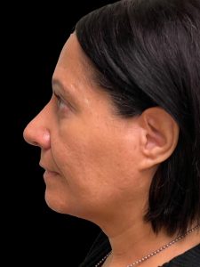 Photo of the patient’s face after the Rhinoplasty surgery. Patient 3 - Set 3