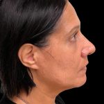 Photo of the patient’s face after the Rhinoplasty surgery. Patient 3 - Set 5