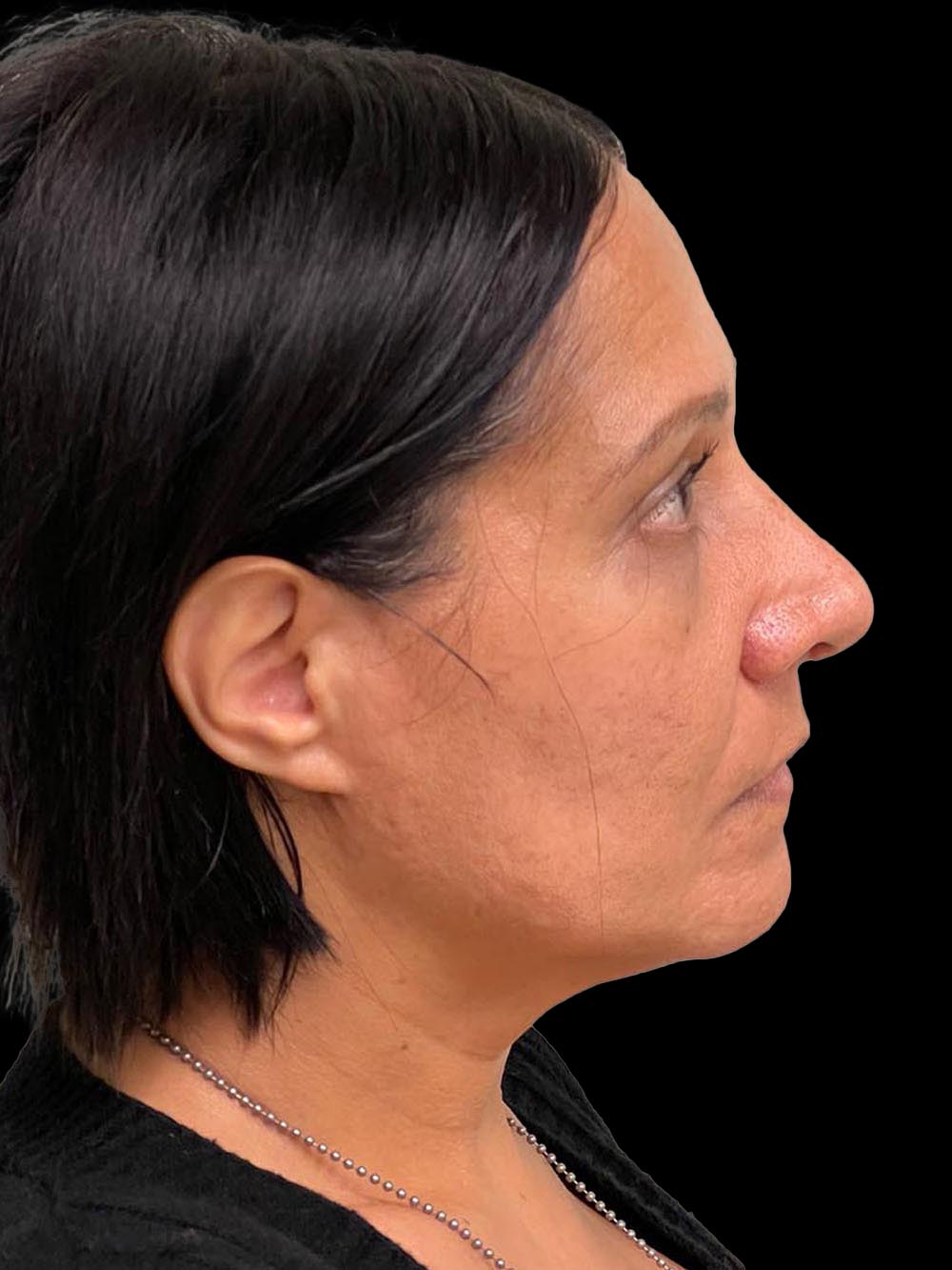 Photo of the patient’s face after the Rhinoplasty surgery. Patient 3 - Set 5