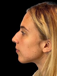 Photo of the patient’s face before the Rhinoplasty surgery. Patient 5 - Set 3